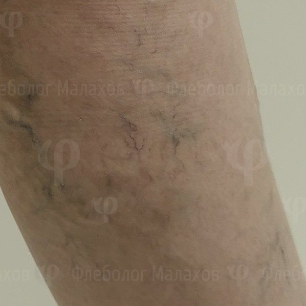 Микросклеротерапия сосудистых звёздочек в Одинцово. Показания — фото 3