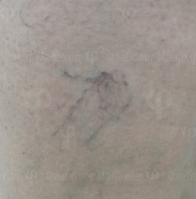 Микросклеротерапия сосудистых звёздочек в Одинцово. Показания — фото 6