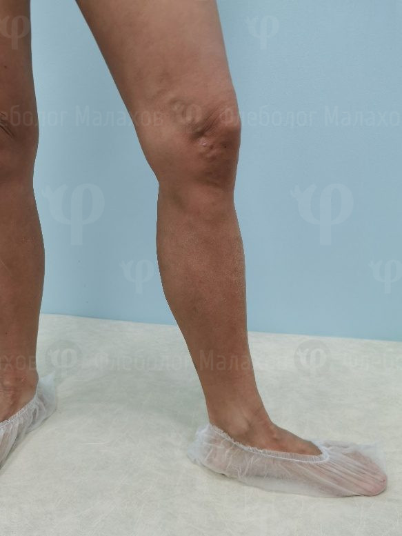 Результаты лечения, фото до и после эстетической минифлебэктомии — фото 6
