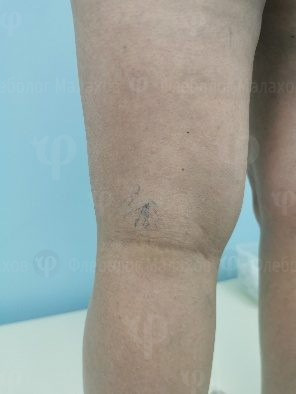 Появились сосудистые звёздочки или сеточка на ногах — фото 2