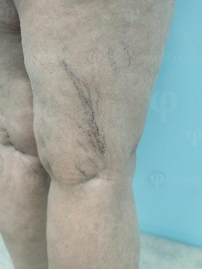 Появились сосудистые звёздочки или сеточка на ногах — фото 6